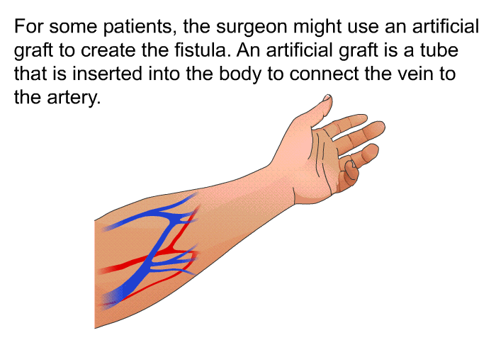 For some patients, the surgeon might use an artificial graft to create the fistula. An artificial graft is a tube that is inserted into the body to connect the vein to the artery.