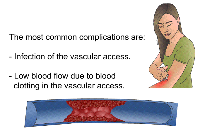 The most common complications are:  Infection of the vascular access. Low blood flow due to blood clotting in the vascular access.