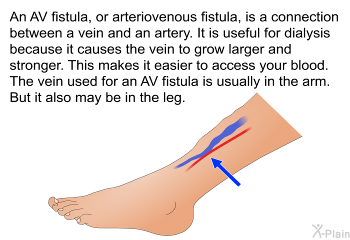 An AV fistula, or arteriovenous fistula, is a connection between a vein and an artery. It is useful for dialysis because it causes the vein to grow larger and stronger. This makes it easier to access your blood. The vein used for an AV fistula is usually in the arm. But it also may be in the leg.