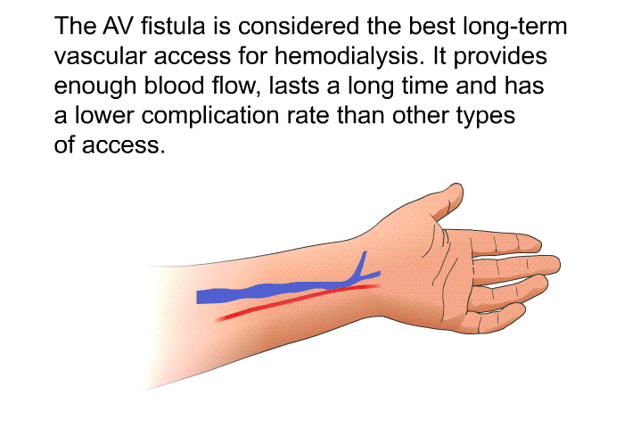 The AV fistula is considered the best long-term vascular access for hemodialysis. It provides enough blood flow, lasts a long time and has a lower complication rate than other types of access.