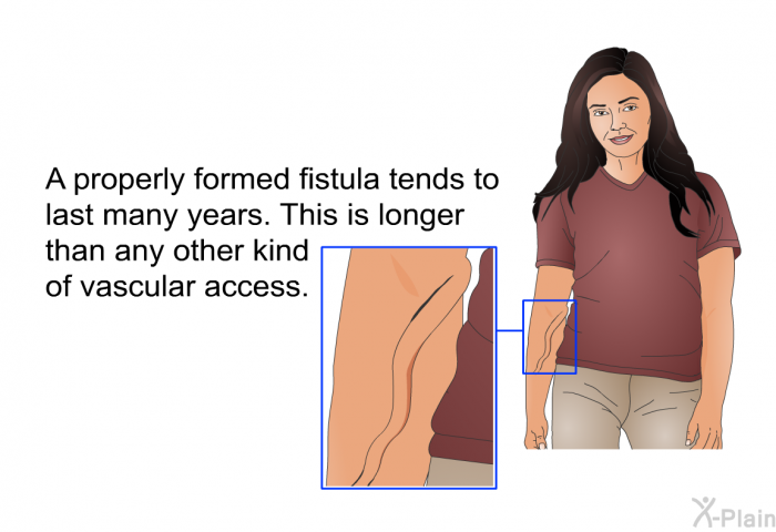 A properly formed fistula tends to last many years. This is longer than any other kind of vascular access.
