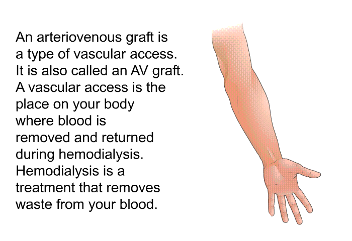 An arteriovenous graft is a type of vascular access. It is also called an AV graft. A vascular access is the place on your body where blood is removed and returned during hemodialysis. Hemodialysis is a treatment that removes waste from your blood.