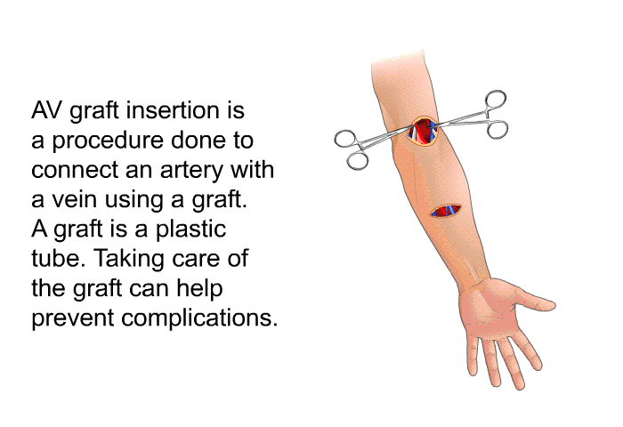 AV graft insertion is a procedure done to connect an artery with a vein using a graft. A graft is a plastic tube. Taking care of the graft can help prevent complications.