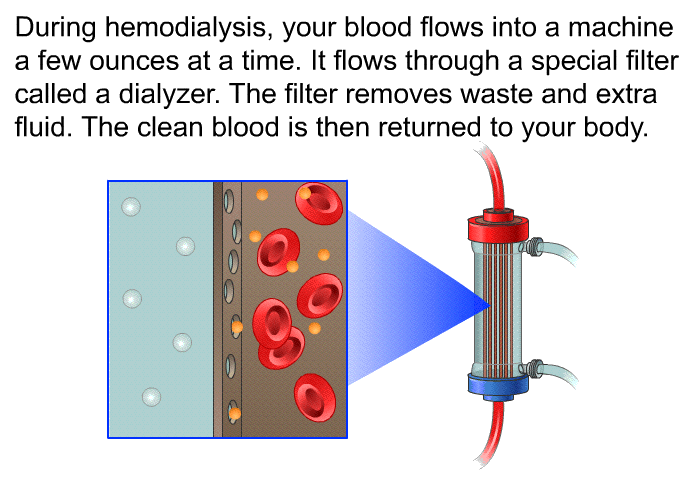 During hemodialysis, your blood flows into a machine a few ounces at a time. It flows through a special filter called a dialyzer. The filter removes waste and extra fluid. The clean blood is then returned to your body.
