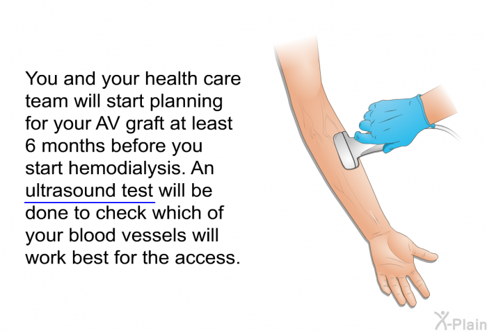 You and your health care team will start planning for your AV graft at least 6 months before you start hemodialysis. An ultrasound test will be done to check which of your blood vessels will work best for the access.