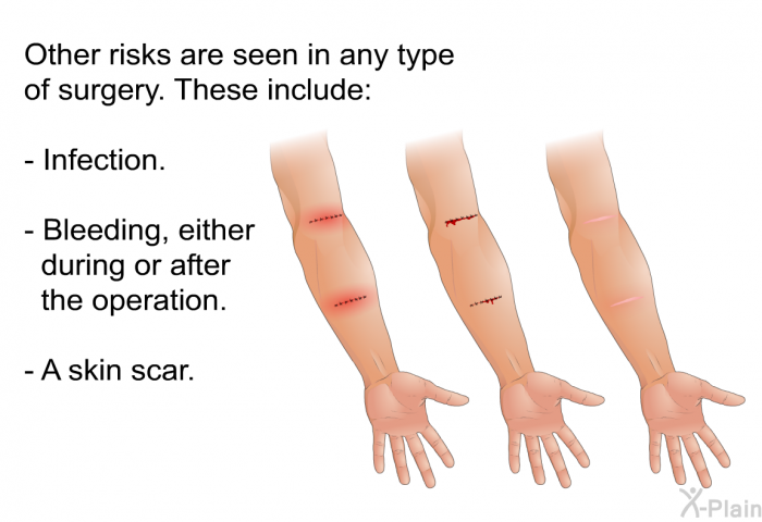 Other risks are seen in any type of surgery. These include:  Infection. Bleeding, either during or after the operation. A skin scar.