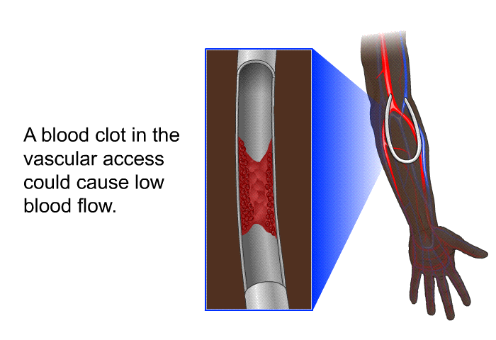 A blood clot in the vascular access could cause low blood flow.
