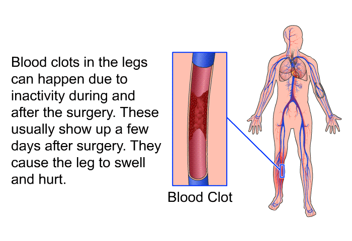 Blood clots in the legs can happen due to inactivity during and after the surgery. These usually show up a few days after surgery. They cause the leg to swell and hurt.