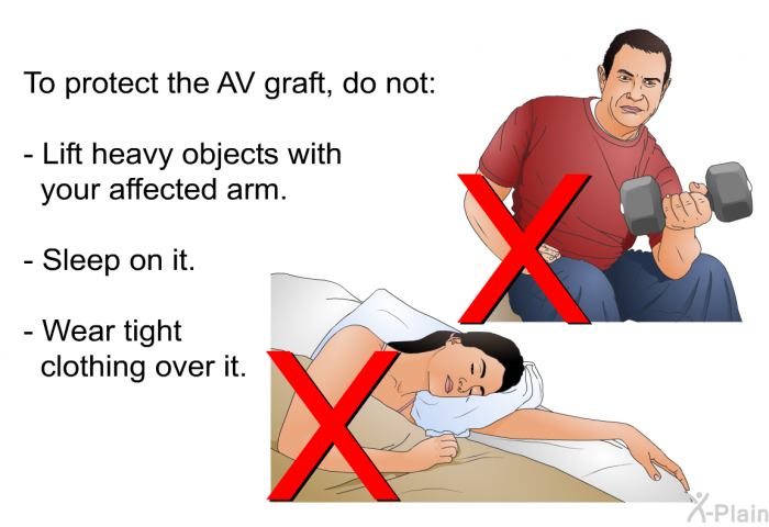 To protect the AV graft, do not:  Lift heavy objects with your affected arm. Sleep on it. Wear tight clothing over it.