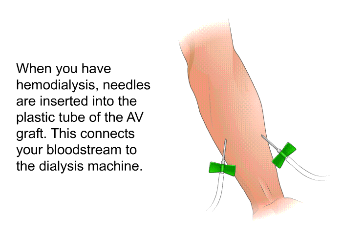 When you have hemodialysis, needles are inserted into the plastic tube of the AV graft. This connects your bloodstream to the dialysis machine.
