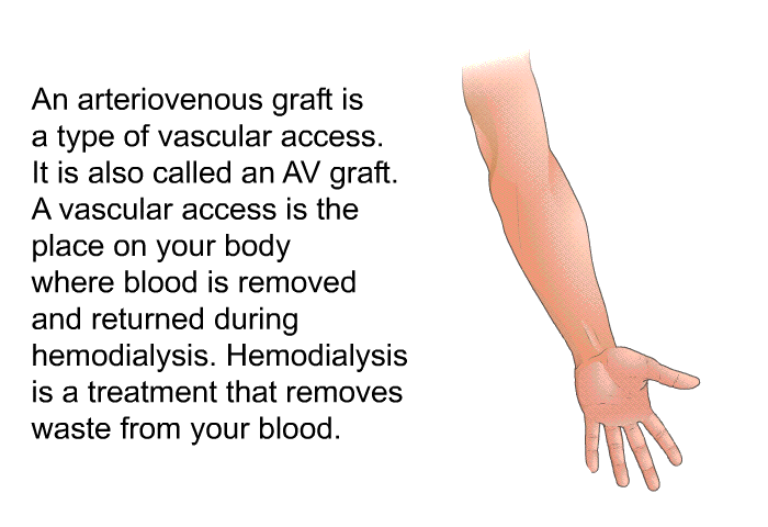 An arteriovenous graft is a type of vascular access. It is also called an AV graft. A vascular access is the place on your body where blood is removed and returned during hemodialysis. Hemodialysis is a treatment that removes waste from your blood.