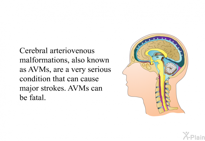Cerebral arteriovenous malformations, also known as AVMs, are a very serious condition that can cause major strokes. AVMs can be fatal.