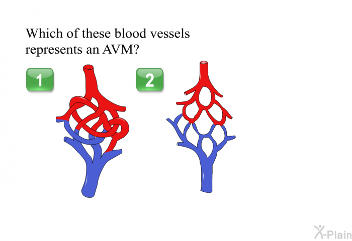 Which of these blood vessels represents an AVM?