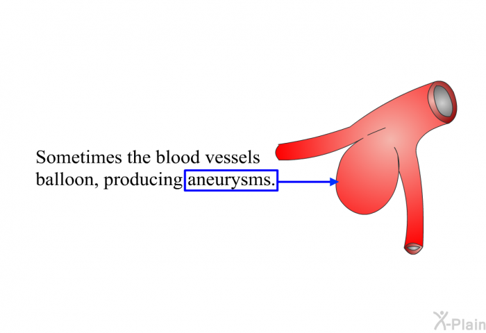 Sometimes the blood vessels balloon, producing aneurysms.