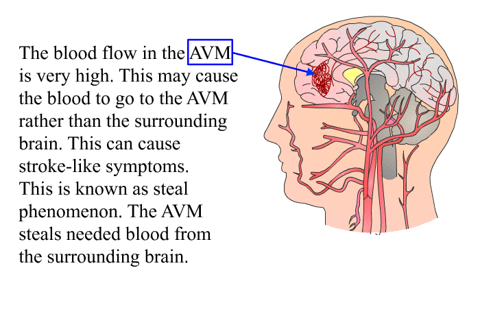 The blood flow in the AVM is very high. This may cause the blood to go to the AVM rather than the surrounding brain. This can cause stroke-like symptoms. This is known as steal phenomenon. The AVM steals needed blood from the surrounding brain.
