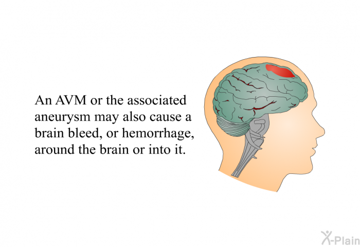 An AVM or the associated aneurysm may also cause a brain bleed, or hemorrhage, around the brain or into it.
