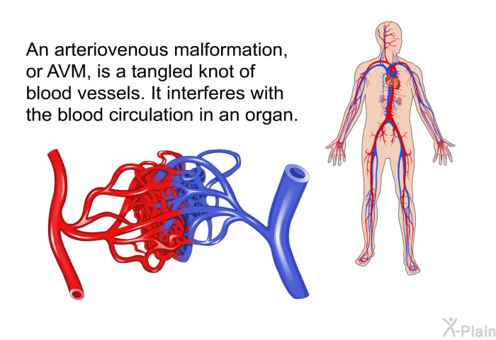 An arteriovenous malformation, or AVM, is a tangled knot of blood vessels. It interferes with the blood circulation in an organ.