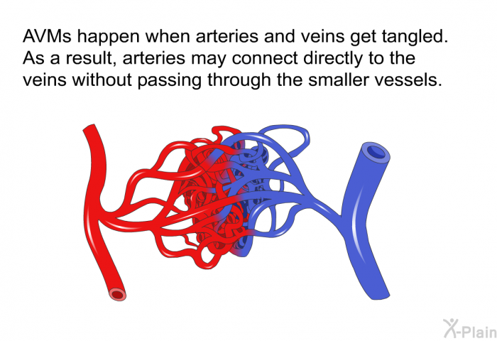 AVMs happen when arteries and veins get tangled. As a result, arteries may connect directly to the veins without passing through the smaller vessels.
