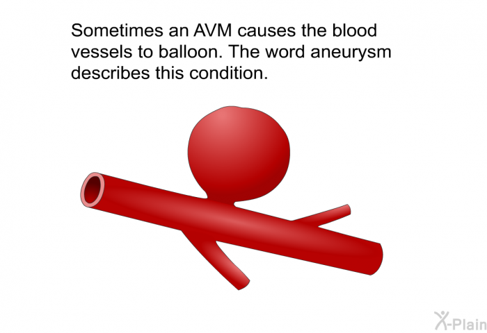 Sometimes an AVM causes the blood vessels to balloon. The word aneurysm describes this condition.