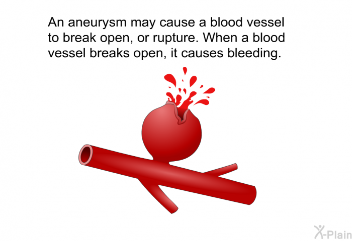 An aneurysm may cause a blood vessel to break open, or rupture. When a blood vessel breaks open, it causes bleeding.