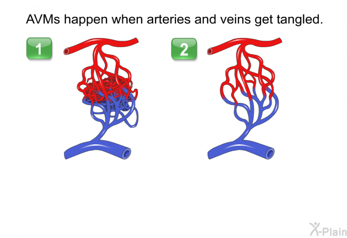 AVMs happen when arteries and veins get tangled.