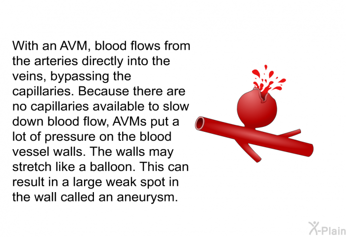 With an AVM, blood flows from the arteries directly into the veins, bypassing the capillaries. Because there are no capillaries available to slow down blood flow, AVMs put a lot of pressure on the blood vessel walls. The walls may stretch like a balloon. This can result in a large weak spot in the wall called an aneurysm.