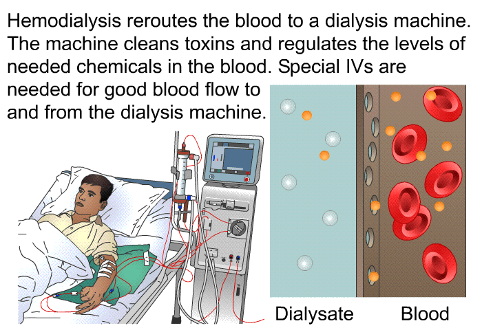 Hemodialysis reroutes the blood to a dialysis machine. The machine cleans toxins and regulates the levels of needed chemicals in the blood. Special IVs are needed for good blood flow to and from the dialysis machine.