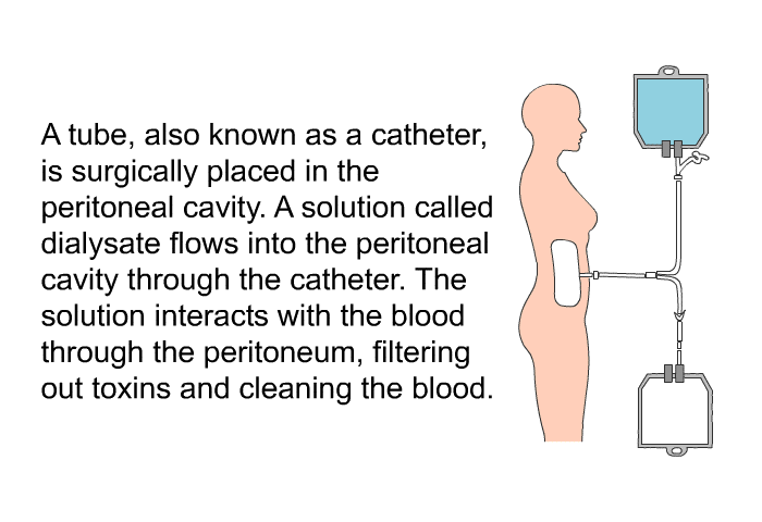 A tube, also known as a catheter, is surgically placed in the peritoneal cavity. A solution called dialysate flows into the peritoneal cavity through the catheter. The solution interacts with the blood through the peritoneum, filtering out toxins and cleaning the blood.
