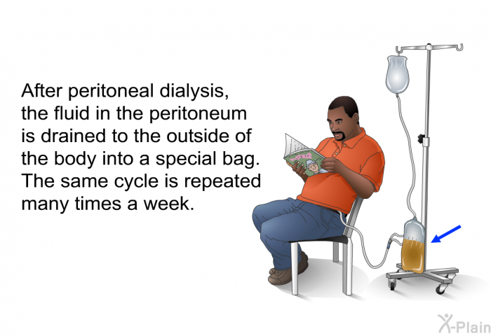 After peritoneal dialysis, the fluid in the peritoneum is drained to the outside of the body into a special bag. The same cycle is repeated many times a week.