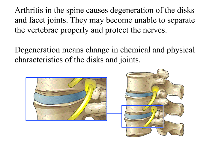 Arthritis in the spine causes degeneration of the disks and facet joints. They may become unable to separate the vertebrae properly and protect the nerves. Degeneration means change in chemical and physical characteristics of the disks and joints.