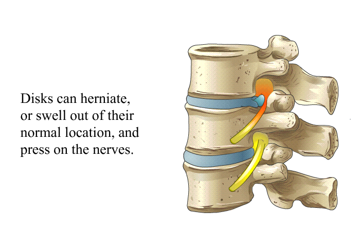 Disks can herniate, or swell out of their normal location, and press on the nerves.