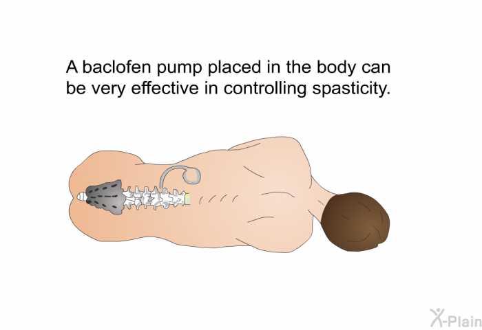 A baclofen pump placed in the body can be very effective in controlling spasticity.