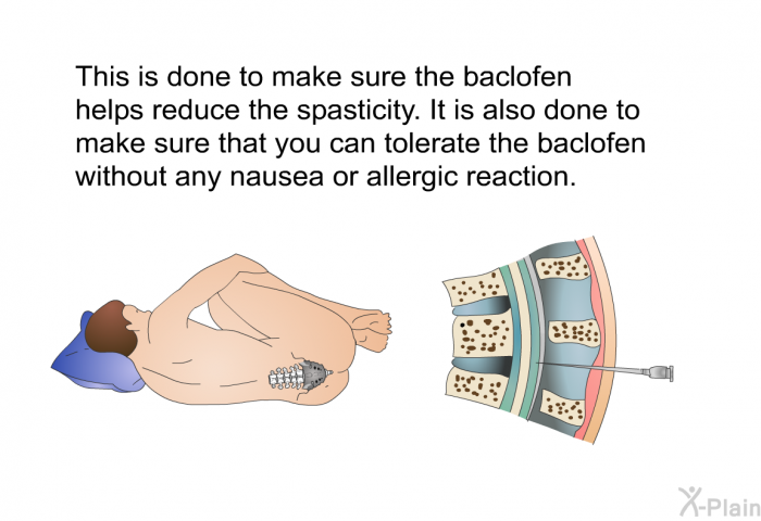 This is done to make sure the baclofen helps reduce the spasticity. It is also done to make sure that you can tolerate the baclofen without any nausea or allergic reaction.