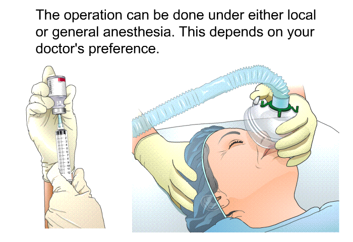 The operation can be done under either local or general anesthesia. This depends on your doctor's preference.