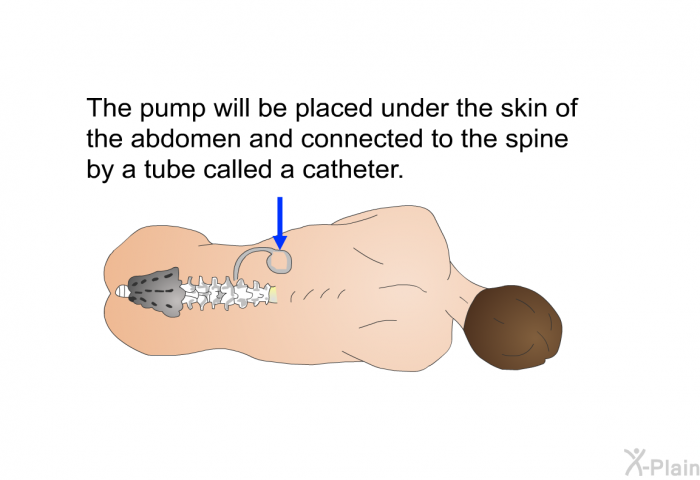 The pump will be placed under the skin of the abdomen and connected to the spine by a tube called a catheter.