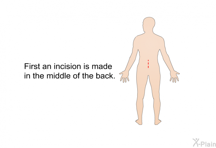 First an incision is made in the middle of the back.