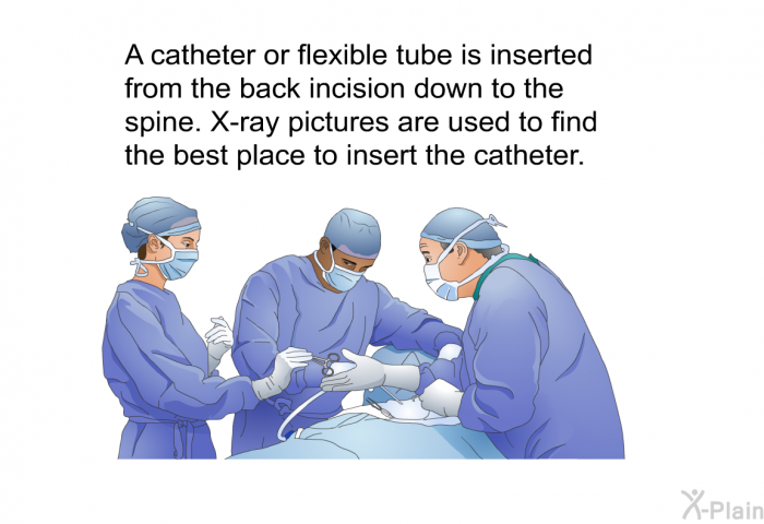 A catheter or flexible tube is inserted from the back incision down to the spine. X-ray pictures are used to find the best place to insert the catheter.