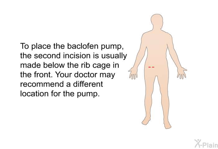 To place the baclofen pump, the second incision is usually made below the rib cage in the front. Your doctor may recommend a different location for the pump.