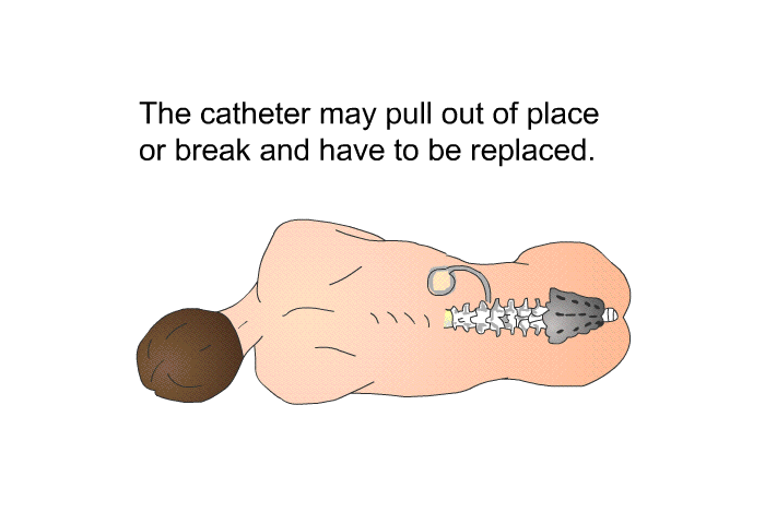 The catheter may pull out of place or break and have to be replaced.