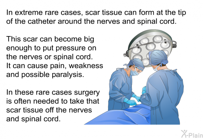 In extreme rare cases, scar tissue can form at the tip of the catheter around the nerves and spinal cord. This scar can become big enough to put pressure on the nerves or spinal cord. It can cause pain, weakness and possible paralysis. In these rare cases surgery is often needed to take that scar tissue off the nerves and spinal cord.