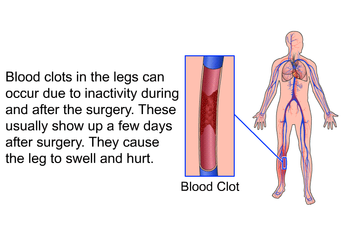 Blood clots in the legs can occur due to inactivity during and after the surgery. These usually show up a few days after surgery. They cause the leg to swell and hurt.