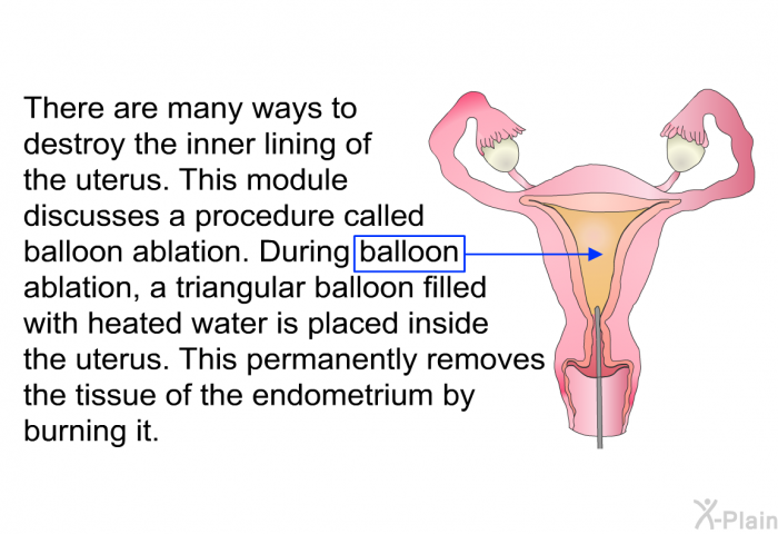 There are many ways to destroy the inner lining of the uterus. This module discusses a procedure called balloon ablation. During balloon ablation, a triangular balloon filled with heated water is placed inside the uterus. This permanently removes the tissue of the endometrium by burning it.