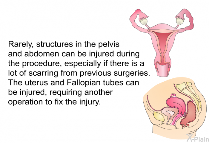 Rarely, structures in the pelvis and abdomen can be injured during the procedure, especially if there is a lot of scarring from previous surgeries. The uterus and Fallopian tubes can be injured, requiring another operation to fix the injury.