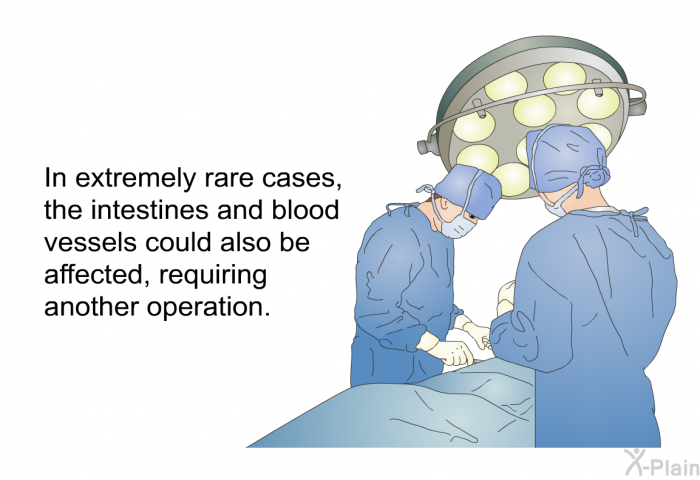 In extremely rare cases, the intestines and blood vessels could also be affected, requiring another operation.