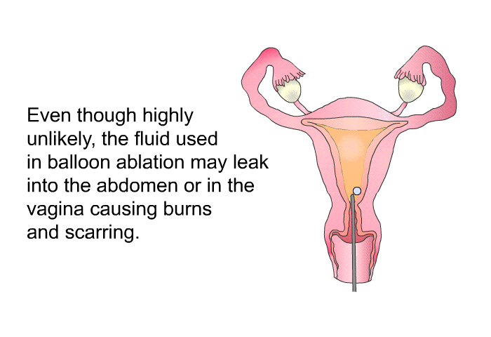 Even though highly unlikely, the fluid used in balloon ablation may leak into the abdomen or in the vagina causing burns and scarring.