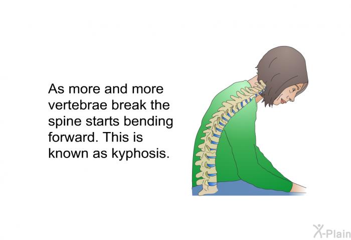 As more and more vertebrae break the spine starts bending forward. This is known as kyphosis.