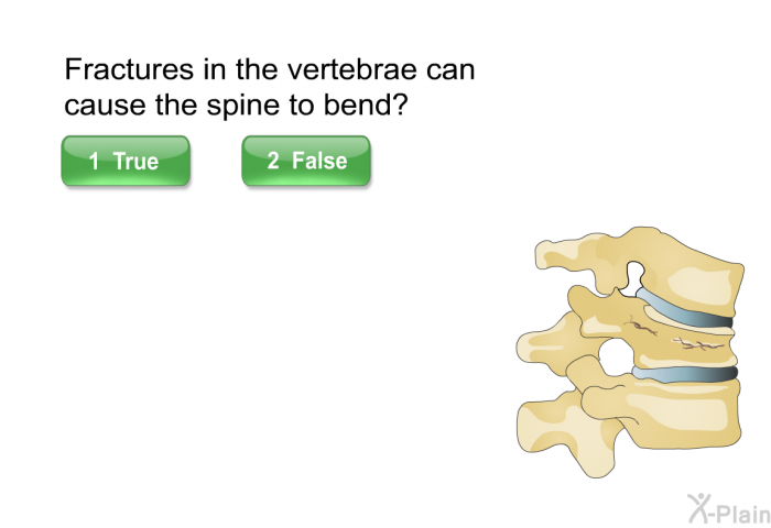 Fractures in the vertebrae can cause the spine to bend. Press True or False