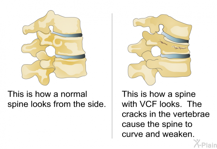 This is how a normal spine looks from the side. This is how a spine with VCF looks. The cracks in the vertebrae cause the spine to curve and weaken.