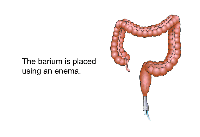 The barium is placed using an enema.