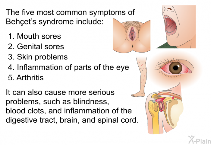 The five most common symptoms of Beh��et’s syndrome include:  Mouth sores Genital sores Skin problems Inflammation of parts of the eye Arthritis  
It can also cause more serious problems, such as blindness, blood clots, and inflammation of the digestive tract, brain, and spinal cord.